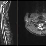 Fig. 4 Postoperative T2-weighted MRI scans of the sagittal (left) and axial (right) planes after a right hemilaminectomy with a complete lesion excision.
