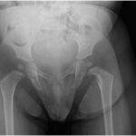 Fig. 1 Anteroposterior radiograph of the pelvis demonstrating a lucent lesion in the left femoral neck with surrounding scalloping. There is also destruction of the medial femoral neck. The acetabular indices are 28° on the left and 30° on the right.
