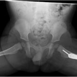 Fig. 10 A frog-leg, lateral-view radiograph of bilateral hips demonstrating well-positioned implants and features consistent with healing.
