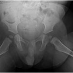 Fig. 2 Frog-leg lateral radiograph of the bilateral hips demonstrating the lucent lesion described earlier with no obvious anterior cortical breakthrough.
