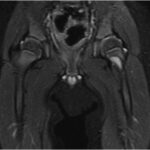 Fig. 3 MRI scan with a 1.5-T-weighted and coronal slices demonstrating an eccentric, cortical-based lesion at the medial anterior femoral neck with a sclerotic border. Periostitis is present, and the lesion did not involve the proximal femoral physis.
