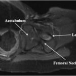 Fig. 4 Axial-view MRI scan of a focal area of anterior cortical breakthrough with a small soft-tissue component at the femoral neck.
