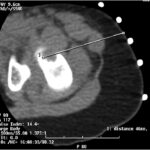 Fig. 5 A CT-guided biopsy of the proximal femoral lesion.
