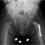 Fig. 8 A 2-week postoperative radiograph demonstrating well-positioned implants with the lesion of the femoral neck still present.
