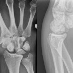 Fig. 1 Initial anteroposterior and lateral radiographs of the right wrist.
