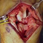 Fig. 3-A Intraoperative photograph demonstrating a volar hamate dislocation and acute scapholunate ligament rupture.
 
 
