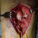 Fig. 3-B Intraoperative photograph demonstrating reduction of the dislocation.
