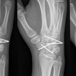 Fig. 4 Postoperative anteroposterior, oblique, and lateral radiographs of the right wrist.
