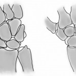 Fig. 6 : Illustrations showing the alignment of the carpal bones, from a dorsal perspective, of a normal right wrist (left panel) and of the wrist of the patient in this case report, demonstrating a volar hamate dislocation, flexion of the scaphoid, increased scapholunate distance, and extension of the lunate (right panel).
